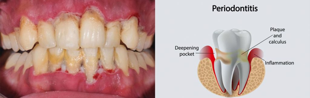 Periodontitis
