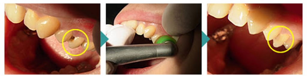 HealOzone endodontic treatment