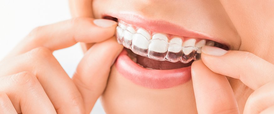 Clear Aligner Treatment