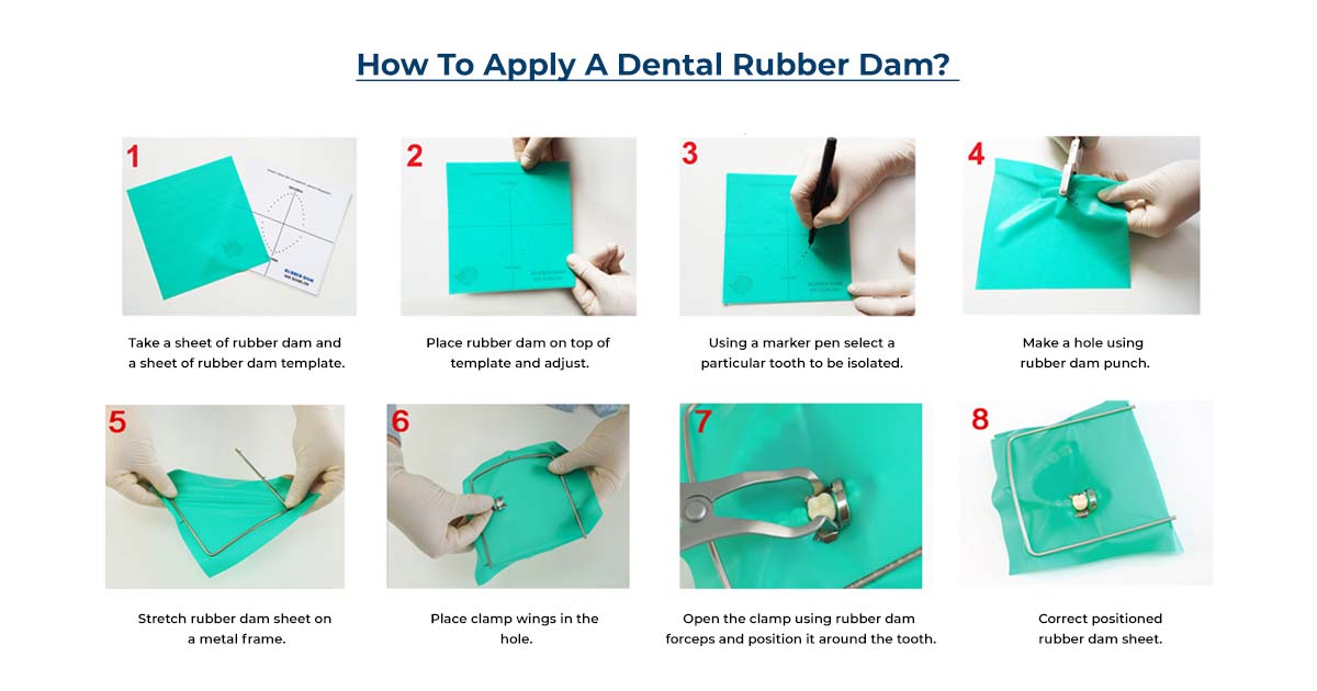 How to Apply a Rubber Dam