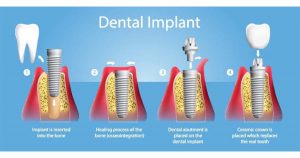 dental implant