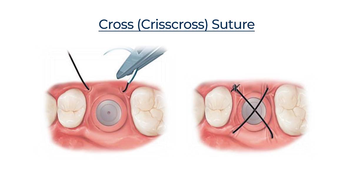 crisscross suture