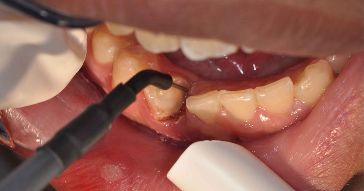 Post operative instructions of Electrosurgery