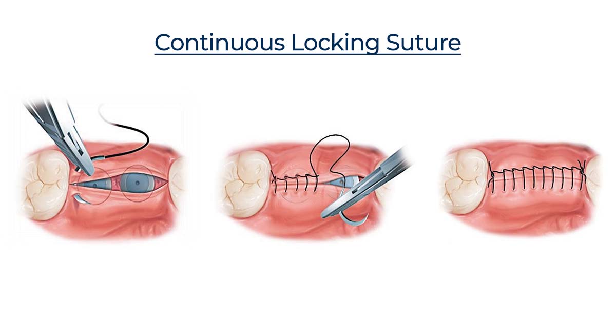 Continuous Locking