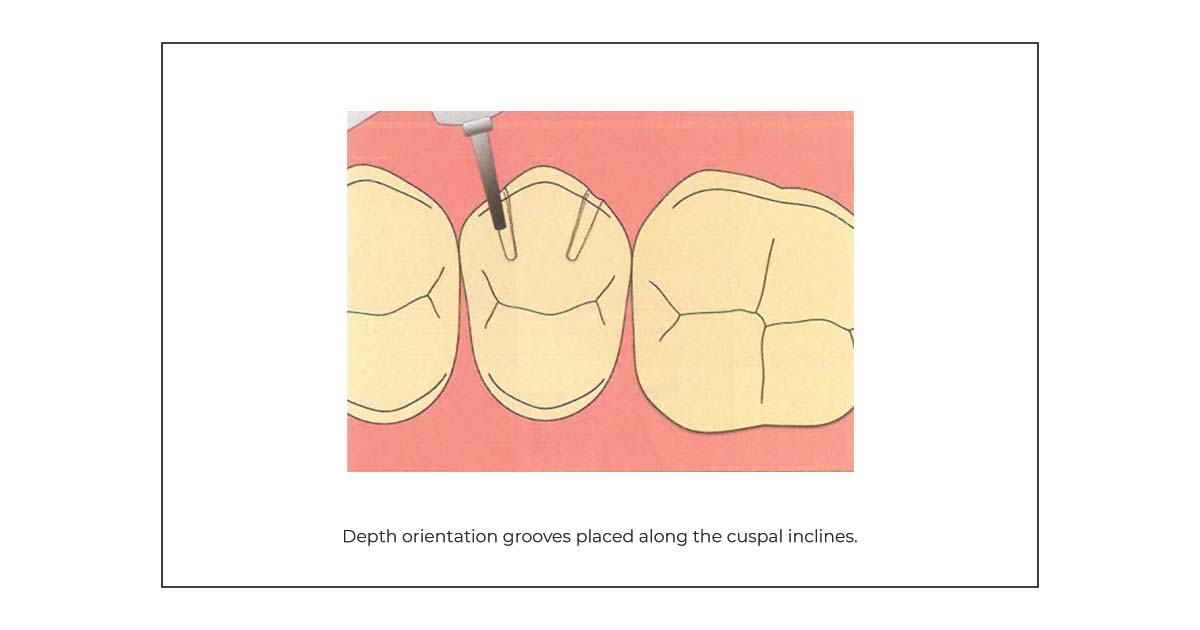 posterior metal ceram tooth prep