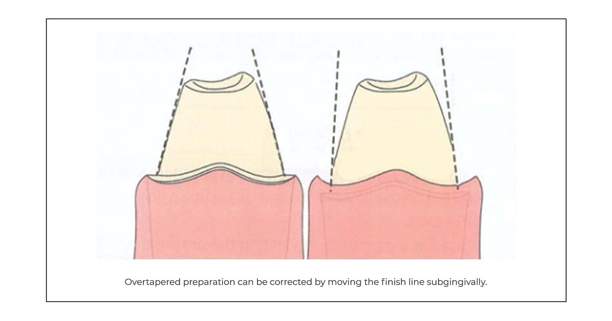 principles of tooth prep