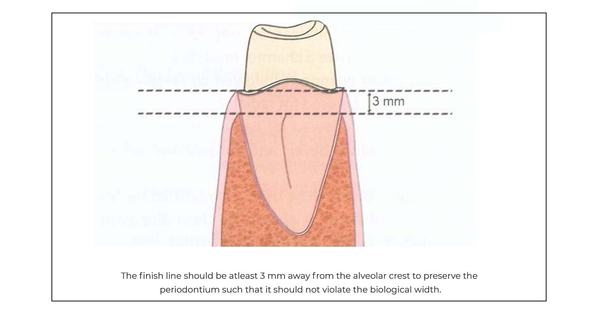 preservation of periodontium 