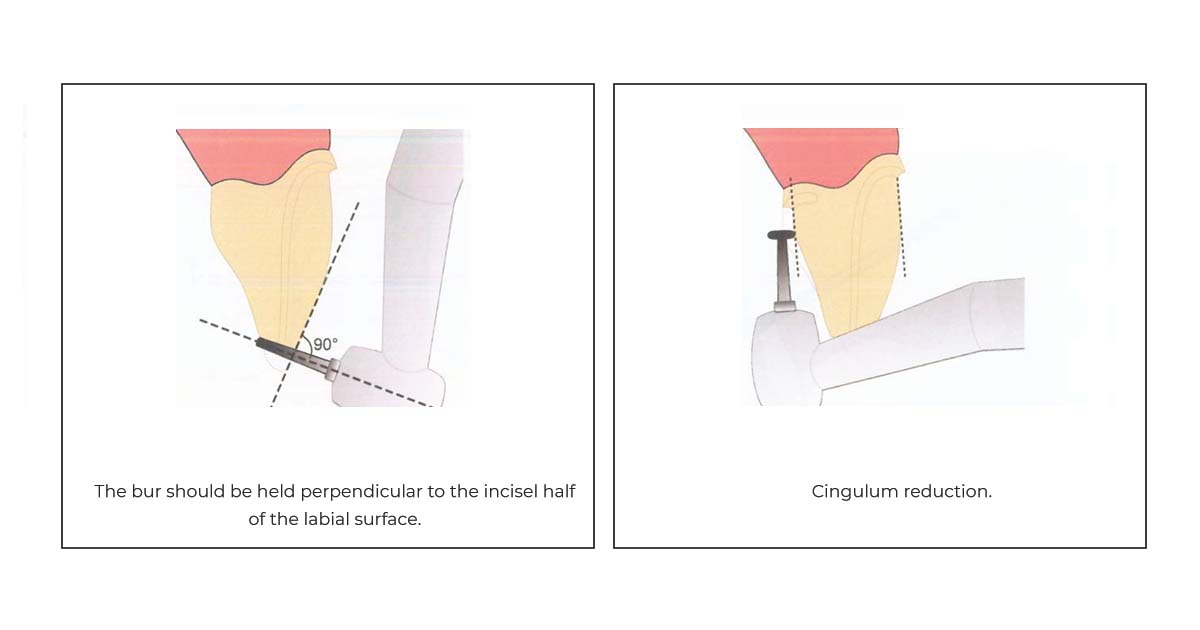 anterior metal ceram tooth prep
