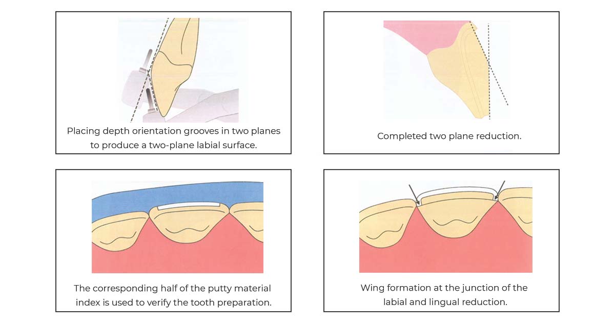 anterior metal ceram tooth prep
