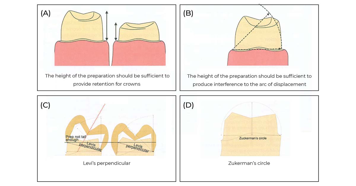 principles of tooth preparation
