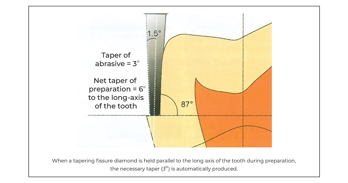 principles of tooth prep