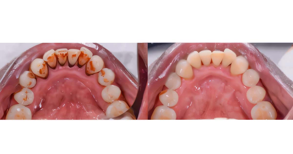 Ultrasonic tooth scaling