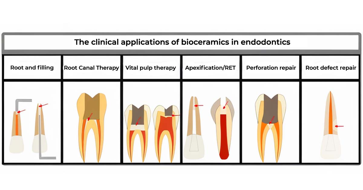bioceramic materials in endodontics