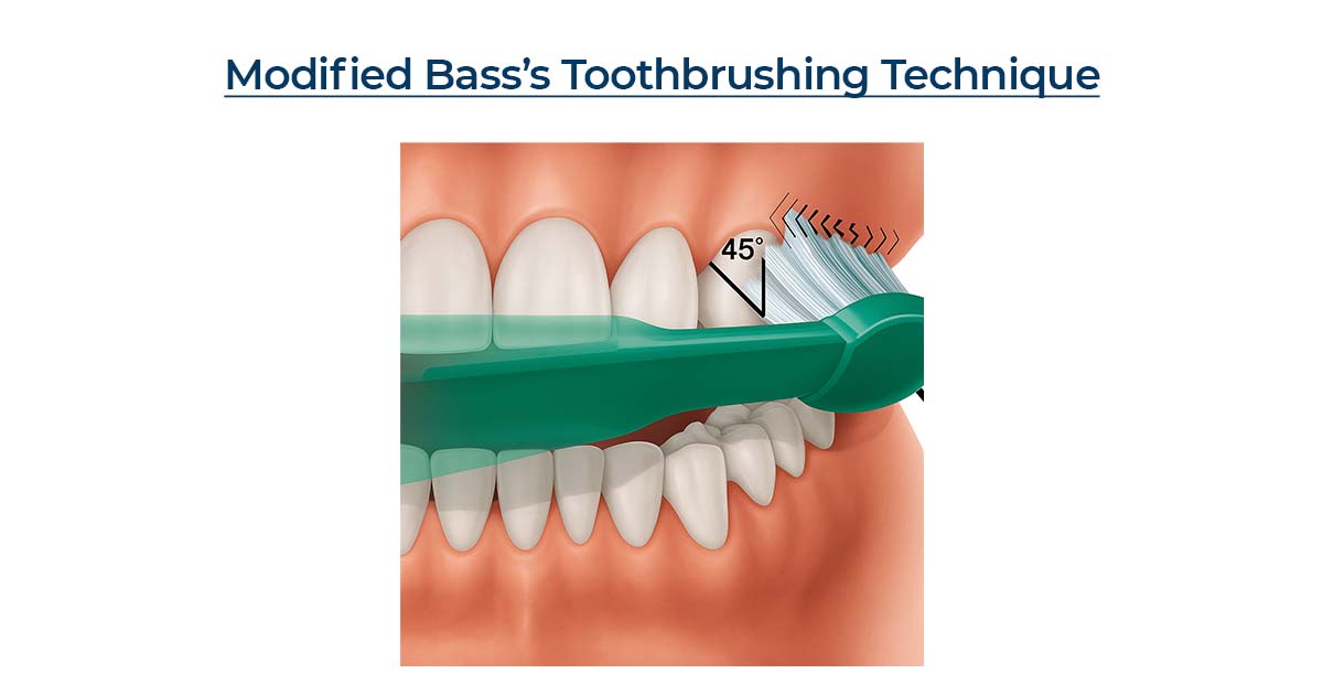 Modified Bass’s Toothbrushing Technique