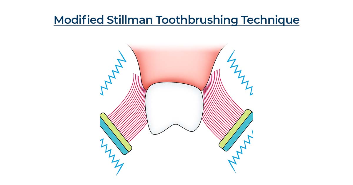Modified Stillman Technique