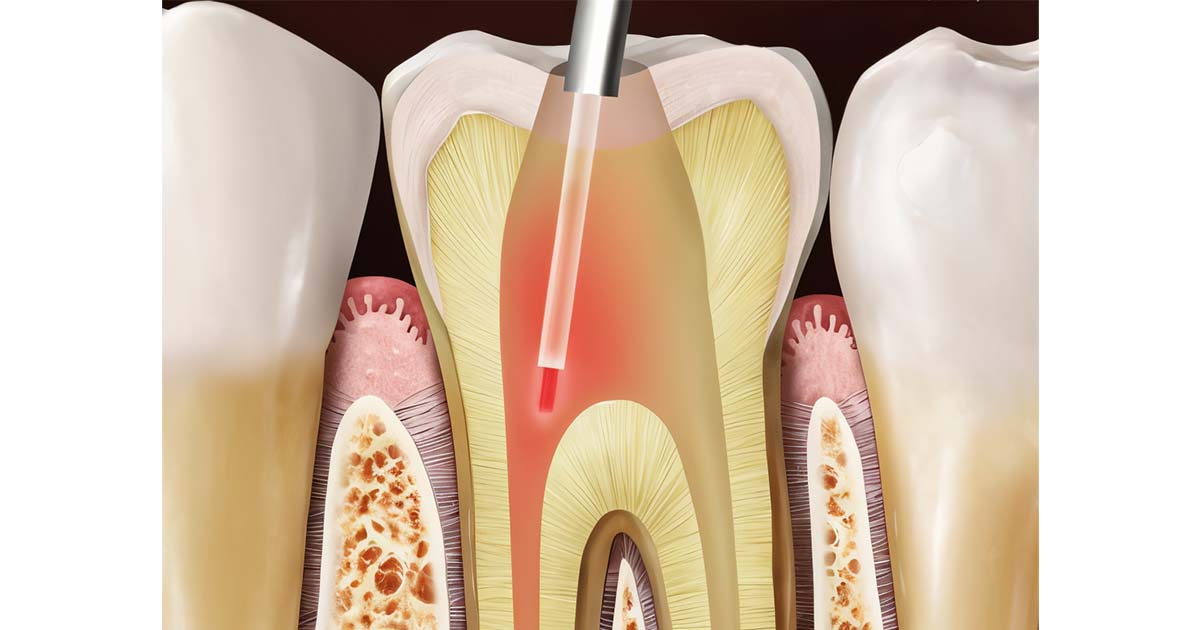 Low level laser therapy