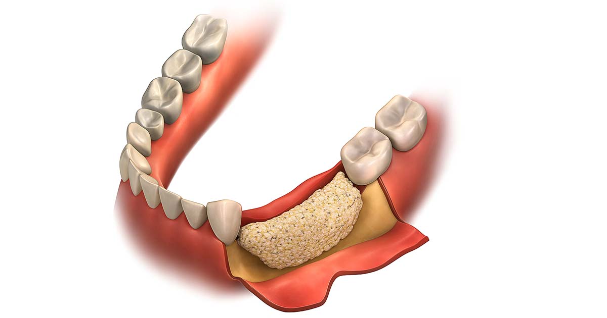 bone graft