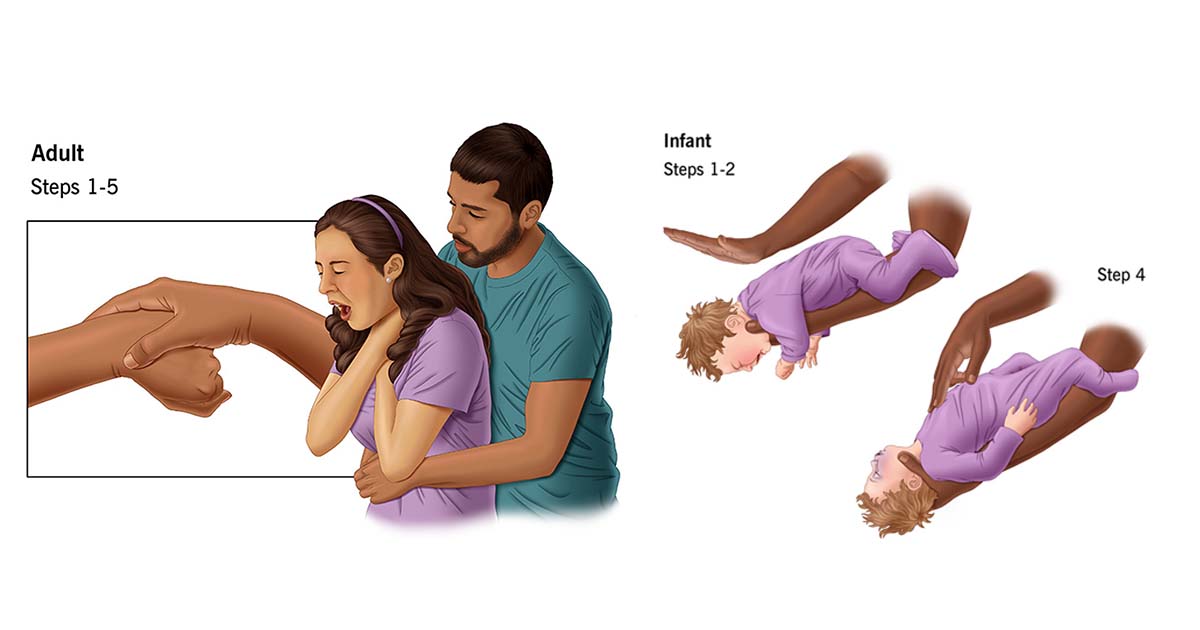 Heimlich maneuver