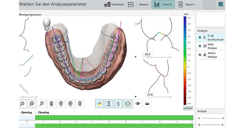 digital occlusion analysis