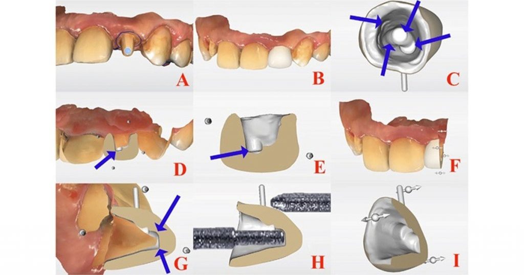 digital workflow of crown