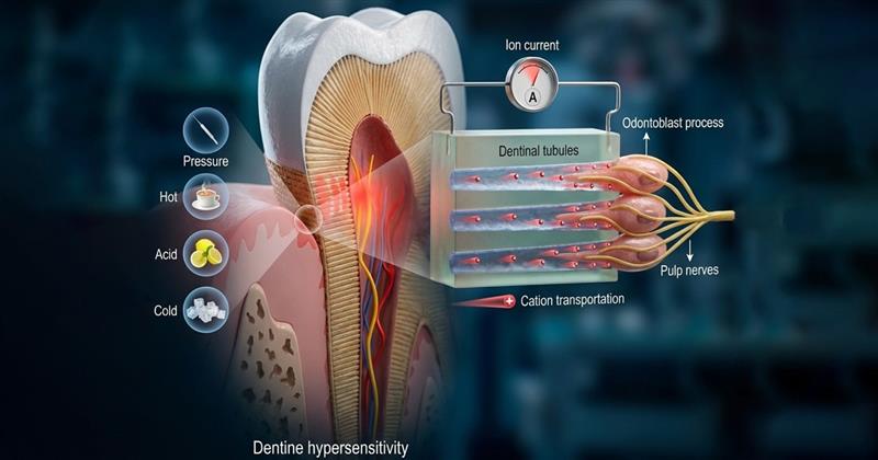 dentine hypersensitivity