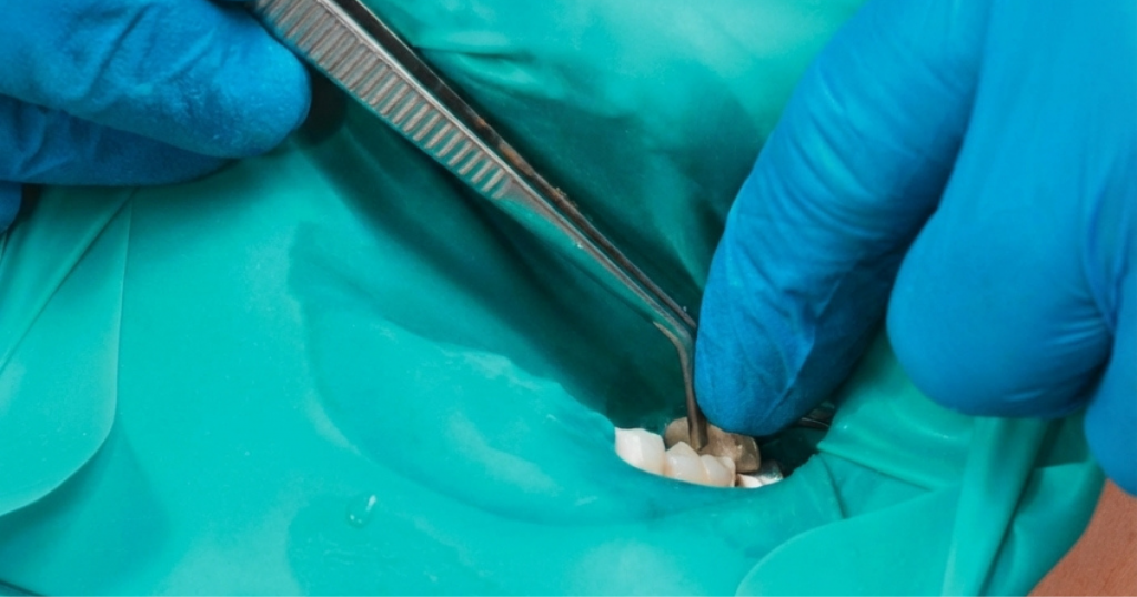 isolation with rubber dam