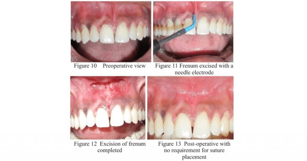laser assisted frenectomy