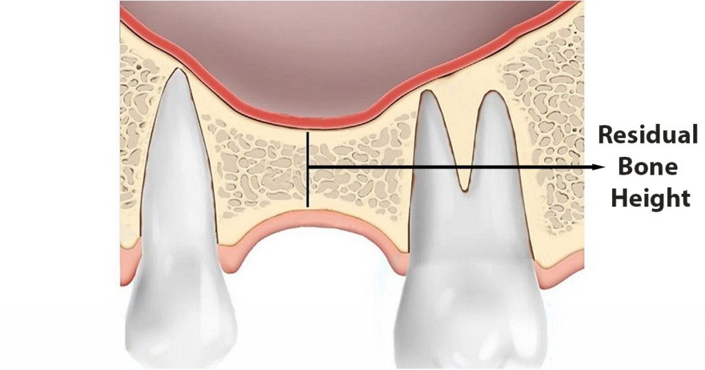 residual bone height