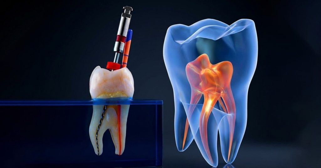 root canal therapy