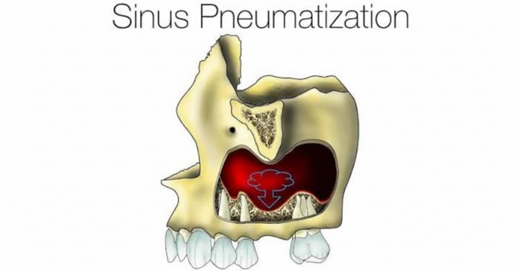 sinus pneumatization