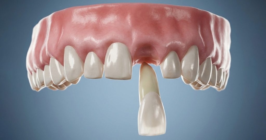 tooth avulsion