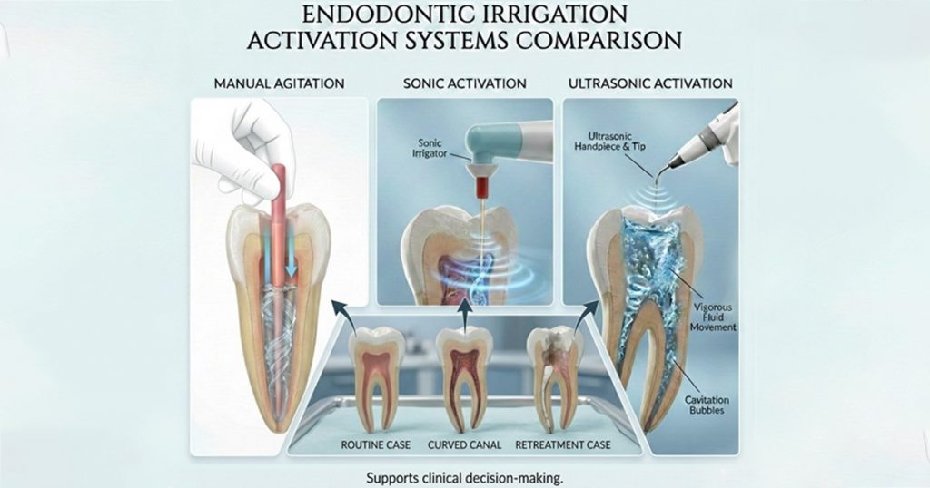 endodontic irrigation activation system comparison