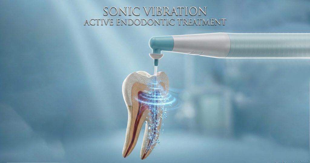 Sonic Irrigation Activation